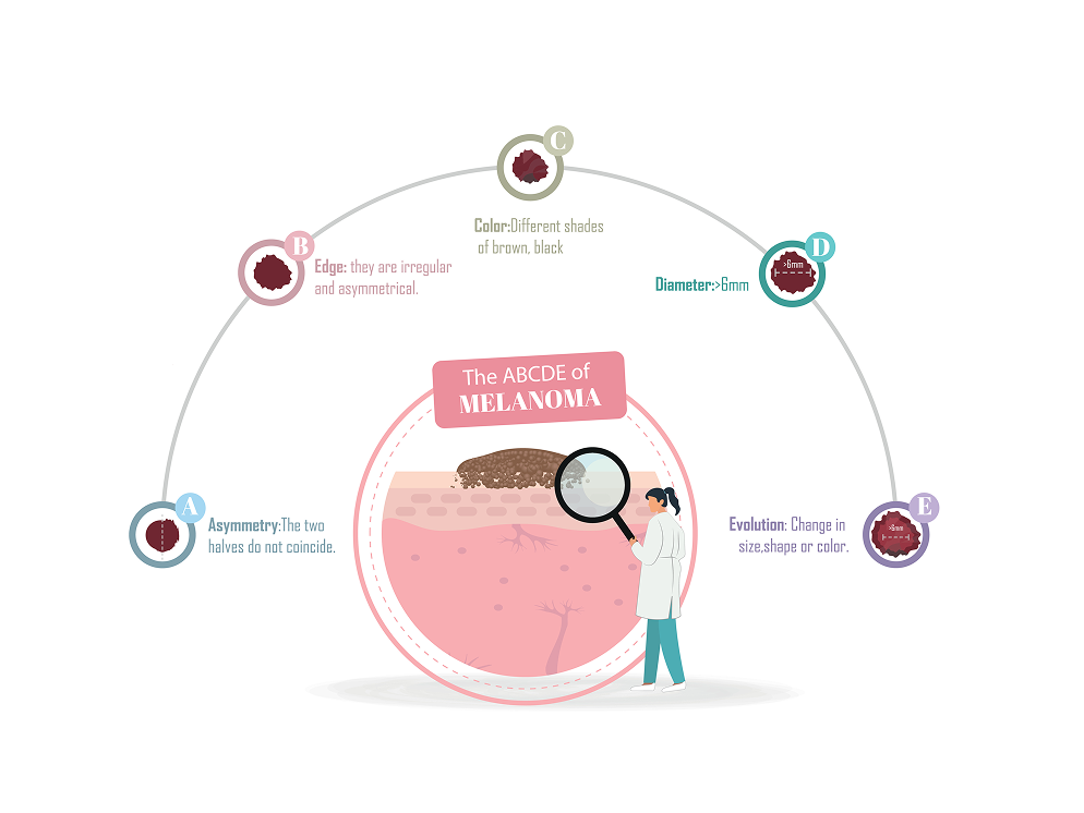 The ABCDE Rule of Melanoma