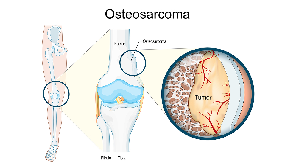 Bone sarcoma